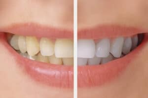 Before and After image of Teeth Whitening Pasadena TX